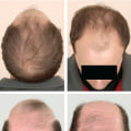 Understanding Medical Treatments for Male Pattern Baldness