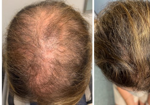 Natural Remedies for Male Pattern Baldness: Solutions for Managing and Storing Digital Content