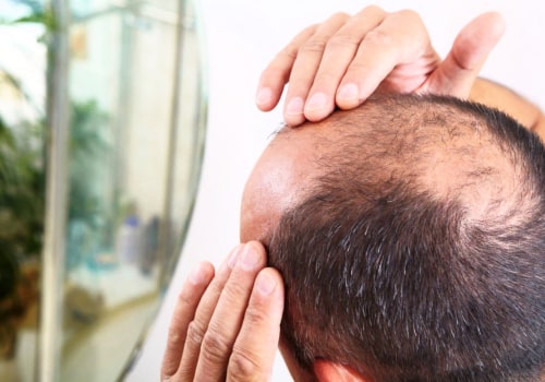 Understanding Male Pattern Baldness: A Comprehensive Guide to Diagnosing and Treating Hair Loss